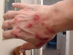Papules and worms on the skin
