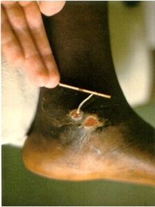 Guinea worm extracted from the legs of patients with dracunculiasis