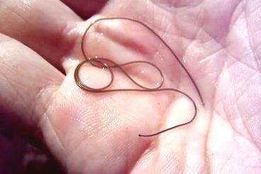 helminth parasites from the human body
